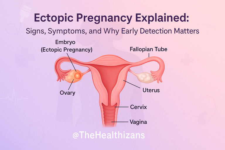 Ectopic Pregnancy Explained