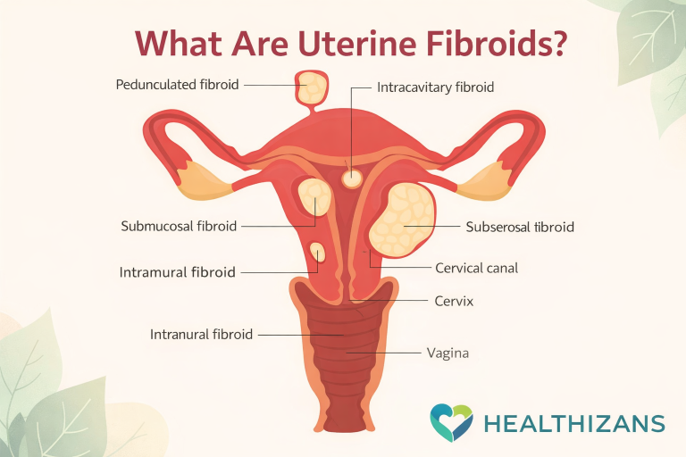 What Are Uterine Fibroids? Causes, Symptoms, and Treatment Options